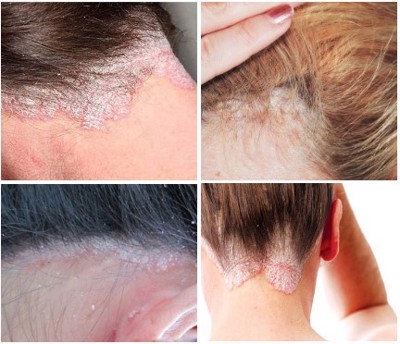 Vảy nến da đầu là bệnh gì? Chữa sao cho hiệu quả, ngăn ngừa tái phát trở lại
